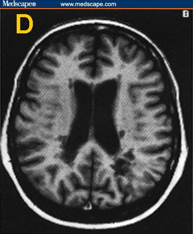 Multiple Sclerosis: Diagnosis and Management Strategies - Page 5