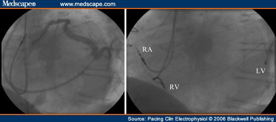 Echo image of right ventricular apex (RVA) pacemaker, pressure