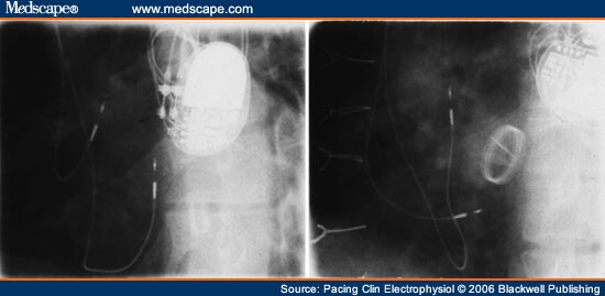 Echo image of right ventricular apex (RVA) pacemaker, pressure