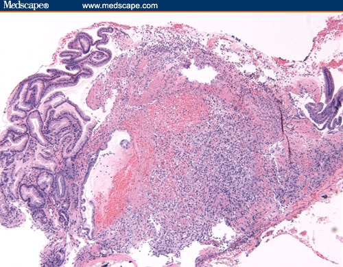 Ewing's Sarcoma Metastasis To The Gastric Wall In A 72-year-old