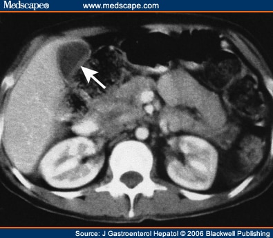 Hepatobiliary and Pancreatic: AIDS Cholangiopathy