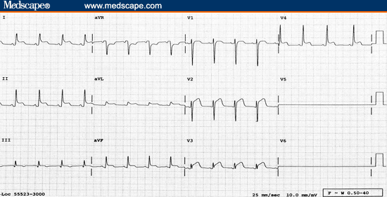 ST Elevation in Precordial Leads (I)