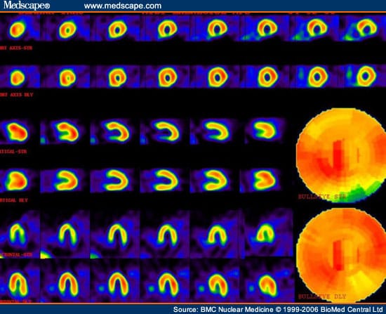 Frequency and Severity of Myocardial Perfusion Abnormalities - Page 3