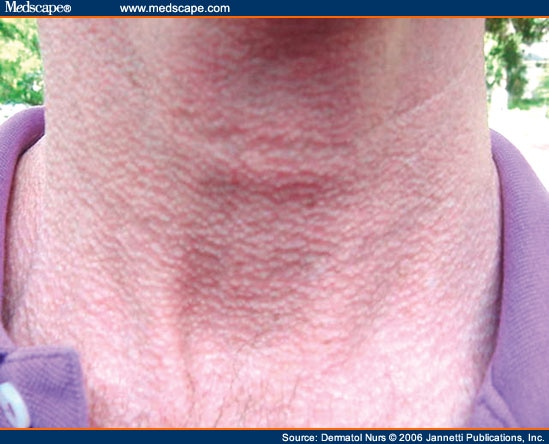 skin tags all over neck