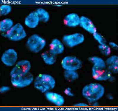 EGFR Protein Expression and Gene Amplification in NSCLC