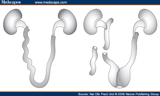 Panurothelial Disease in Superficial Bladder Cancer