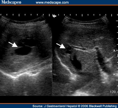 Spontaneous Intrahepatic Portosystemic Venous Shunt