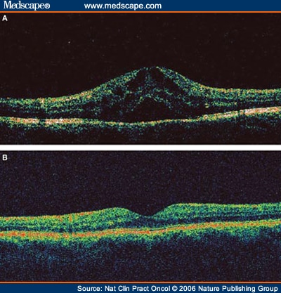 Severe Uveitis in an HLA-B27-positive Patient With Ankylosing ...