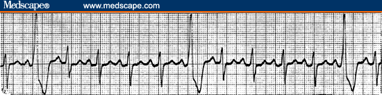 Arrhythmias (I)