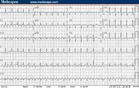 Arrhythmias (IV)