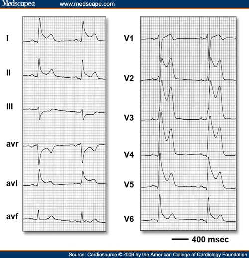 Recognizing Those Electrocardiograms That Distinguish You Smart ...