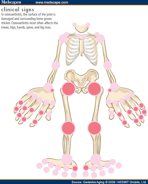 Inflammatory Polyarthritis in the Older Adult