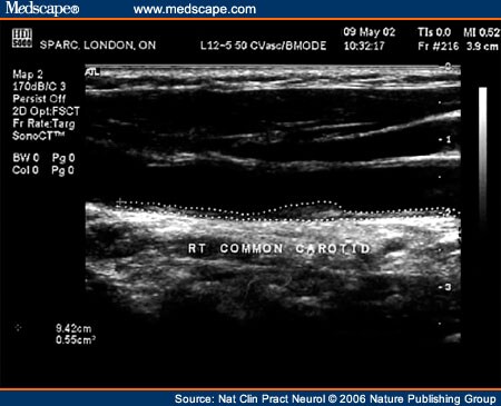 Ultrasound Measurement of Carotid Plaque—Patient Management Ultrasound Measurement of Carotid Plaque—Patient Management