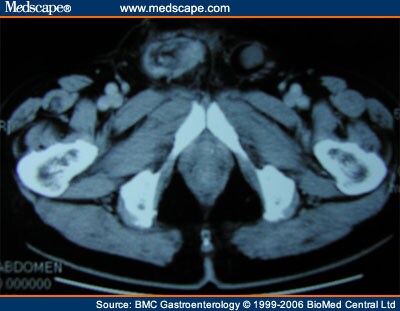 Ruptured Appendiceal Cystadenoma in a Patient With Left Colon Cancer ...