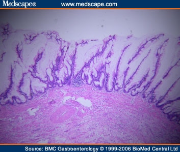 Ruptured Appendiceal Cystadenoma in a Patient With Left Colon Cancer ...