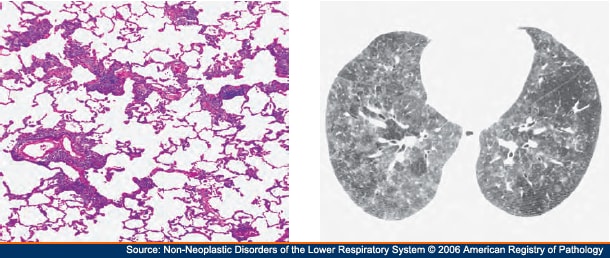 Bronchial Alveolar Lavage Cells