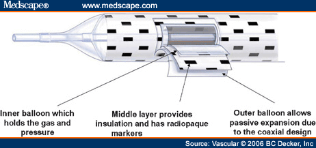 Cryoplasty In The Treatment Of Infrainguinal Arterial Occlusive Disease ...