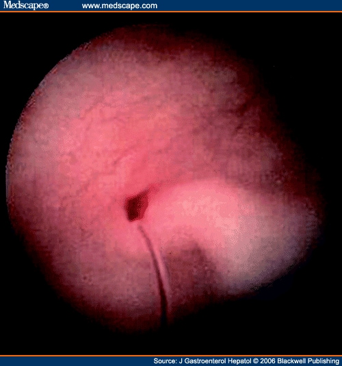 Multiple views of capsule endoscopy showing hook-worms attached to