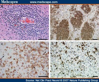 Primary CNS Lymphoma - Page 5