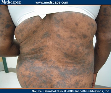 Early Cutaneous T Cell Lymphoma Stages