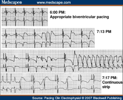 CRT: A Review of Proarrhythmic and Antiarrhythmic Mechanisms - Page 2