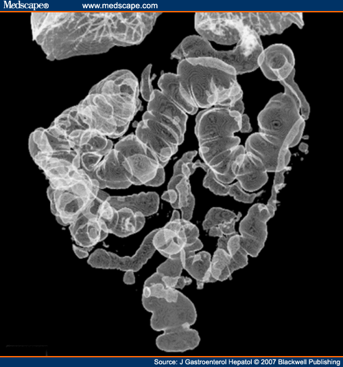 Colonic Stricture After Ischemic Colitis
