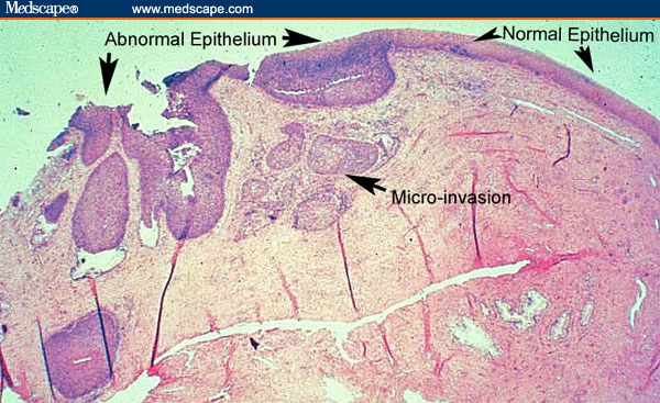 Predicting Persistent/Recurrent Disease in the Cervix - Page 3