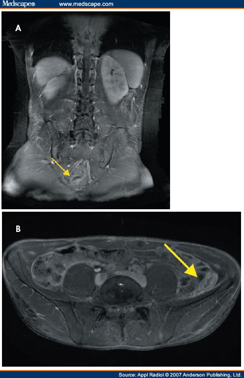 Current Status of MRI in Patients With Inflammatory Bowel Disease Colitis