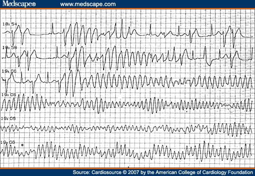 Long QT Syndrome in Adults