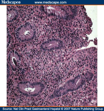 Leukemic infiltration of the anus