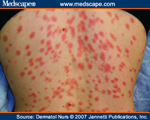 psoriasis treatments medscape