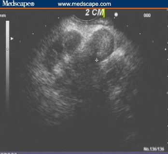 A Case of Pancreatic Lymphoma