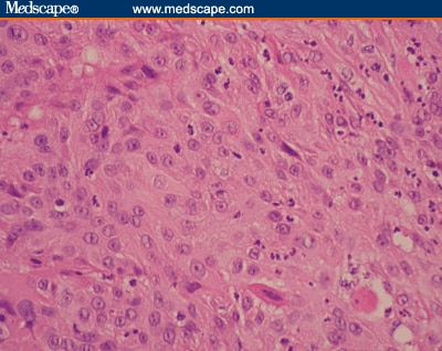 Muscular Metastasis, A Rare Presentation of Non-Small-Cell Lung Cancer