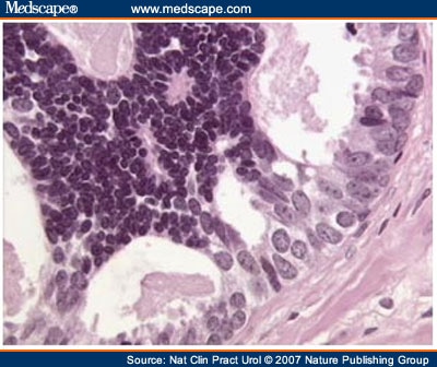 High-Grade Prostatic Intraepithelial Neoplasia - Page 2