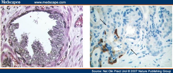 High-Grade Prostatic Intraepithelial Neoplasia - Page 9