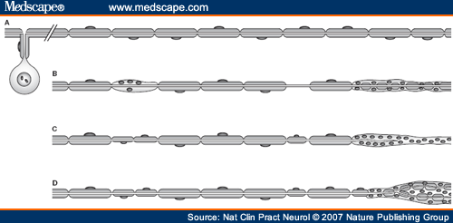 diabetic polyneuropathy medscape