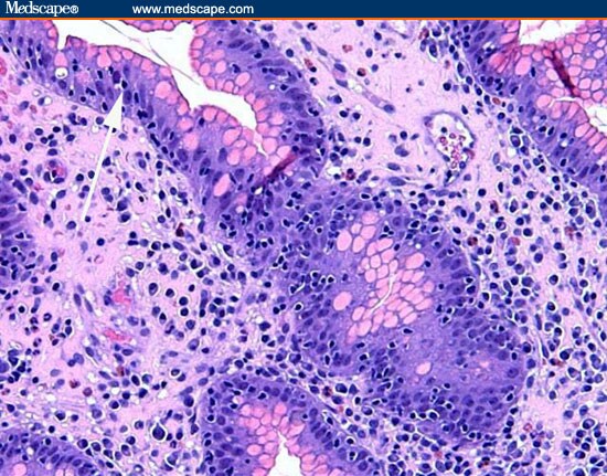 A Man With Rheumatoid Arthritis and Iron-Deficiency Anemia