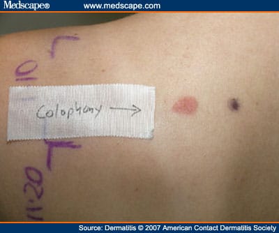 Allergic Contact Dermatitis Caused by Colophony in an Epilating Product ...