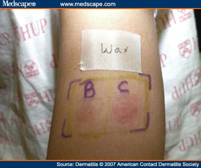 Allergic Contact Dermatitis Caused by Colophony in an Epilating Product ...