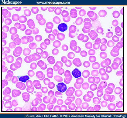 Chronic Lymphocytic Leukemia FISH Panel: Impact on Diagnosis