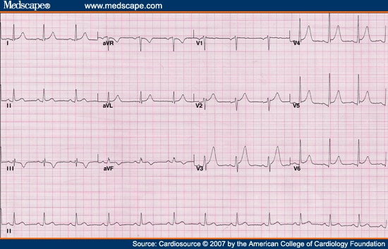 A 47-Year-Old Man Presents for Routine ECG Several Hours After Cardiac Proc