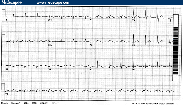 The Electrocardiographic Pattern of Brugada Syndrome - Page 2