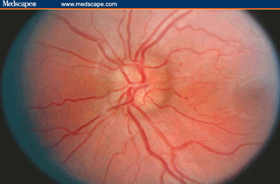 A Child Presenting With Optic Nerve Edema