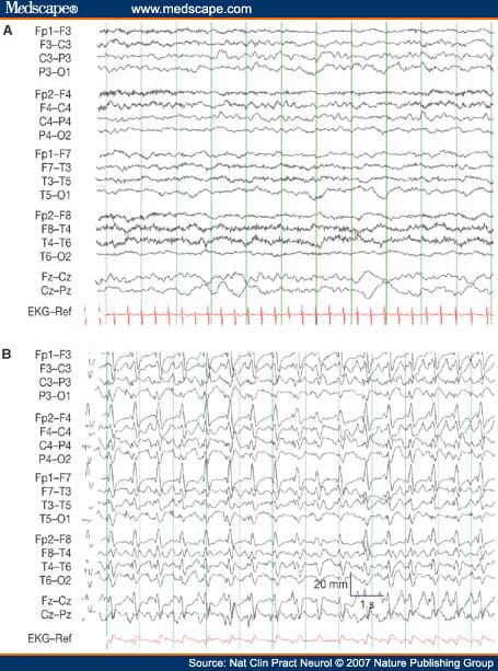 Diagnosis and Management of Nonconvulsive Status Epilepticus in ...