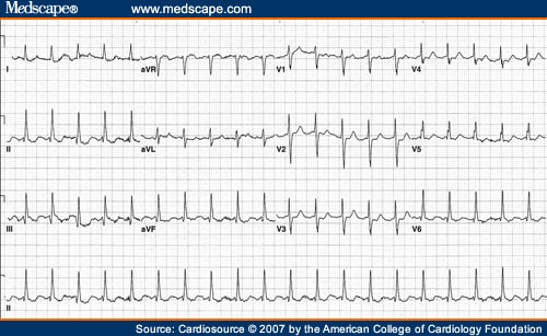 A 73-Year-Old Female Presents With Shortness of Breath and Dyspnea