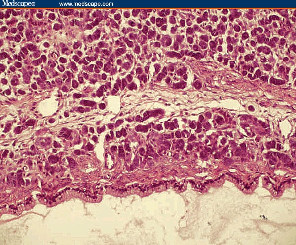 A Ovarian Tumor -- Sertoli-leydig Cell Tumor With Heterologous Element 