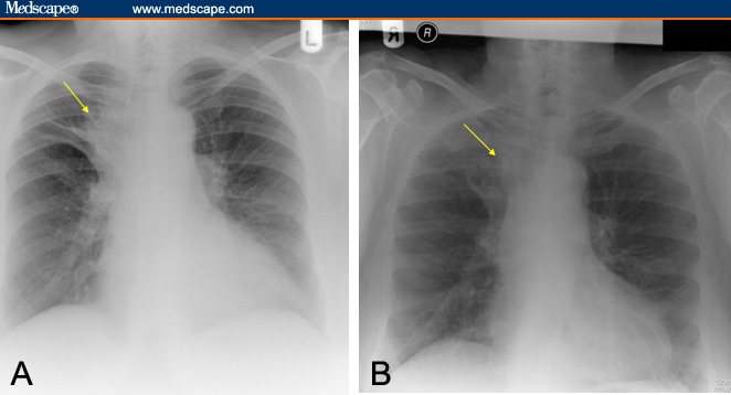 Tracheobronchial Amyloidosis: Utilization of Radiotherapy As Treatment ...