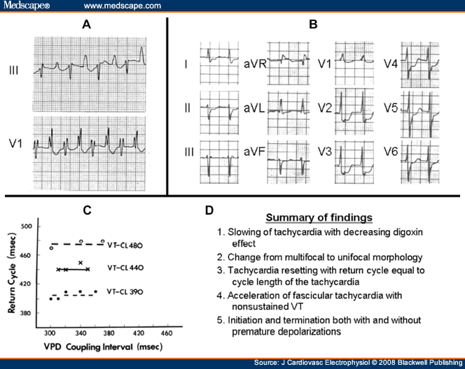 ECG Clues for Diagnosing Ventricular Tachycardia Mechanism