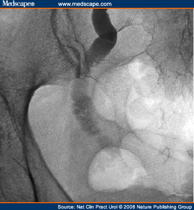 iatrogenic headache ureteric posteroanterior ureter obstruction distal