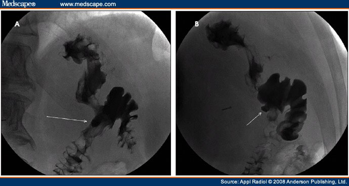 Bariatric Imaging: Technical Aspects and Postoperative Complications